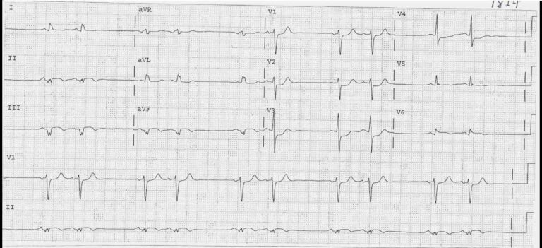 Read more about the article ECG Case 3
