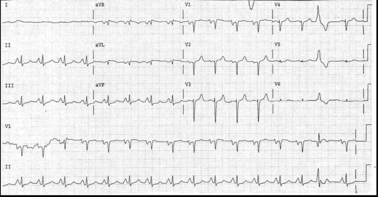 Read more about the article ECG Case 5