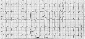 Read more about the article ECG Case 6