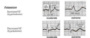 Read more about the article Hypokalemia ECG Changes [With Examples]