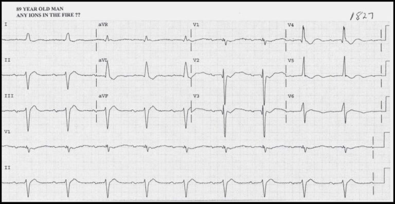 ECG Case 4 Interpretation - Hypokalemia and Hypercalcemia - Manual of ...