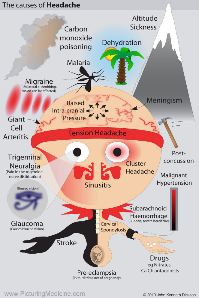 The Causes of Headache