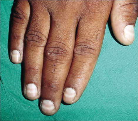 Read more about the article Nail Sign observed in a 19 year old man
