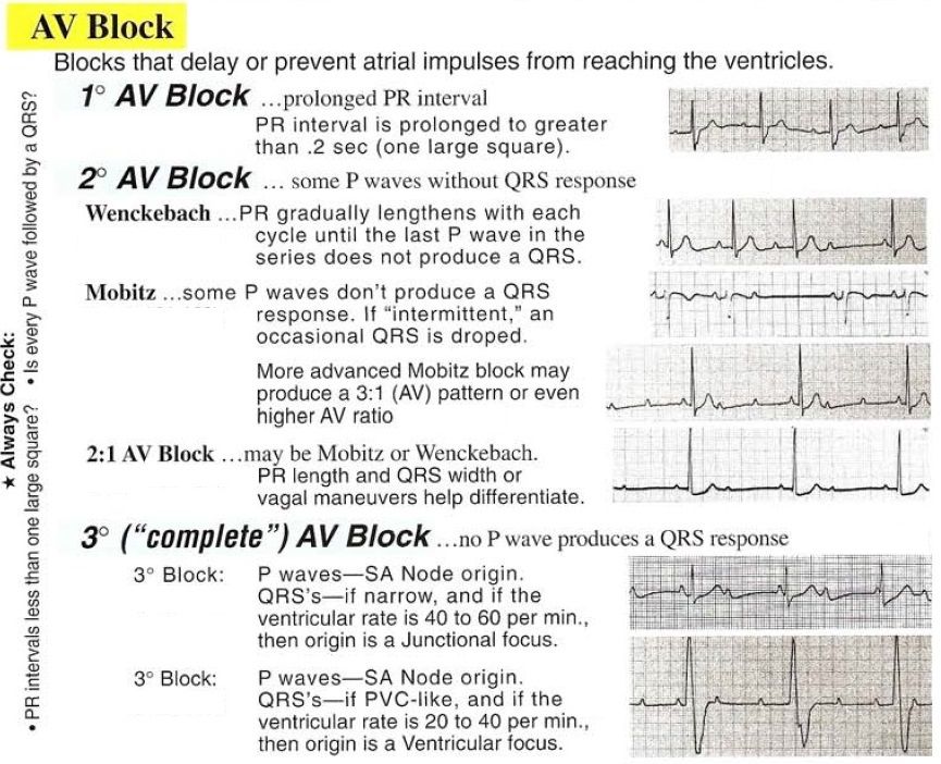 What Are The 3 Types Of Heart Blocks at Guadalupe Matthews blog