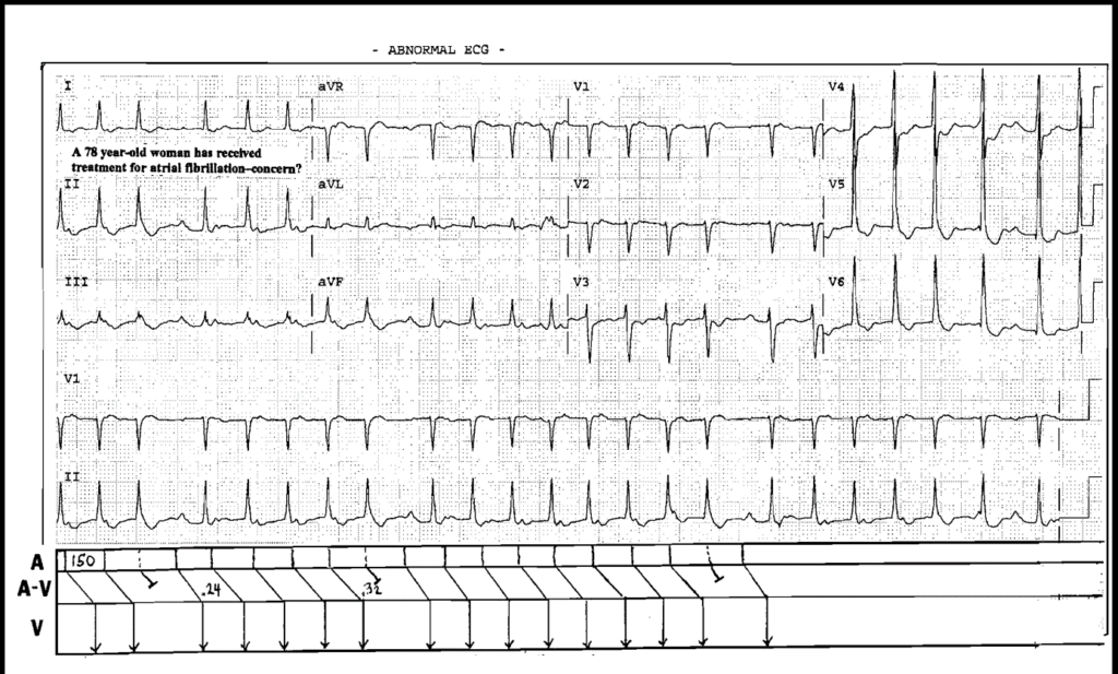 Atrial Tachycardia with AV Block 2nd degree Mobitz I (Wenckebach)