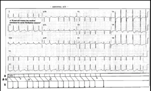 Read more about the article Atrial Tachycardia with 2nd degree AV Block – Mobitz I (Wenckebach)