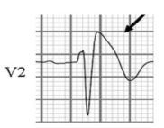 Brugada Syndrome Type 1 - Coved type ST segment elevation