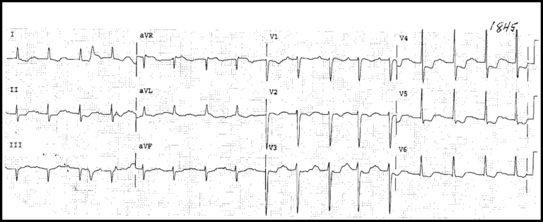 Read more about the article ECG Case 10