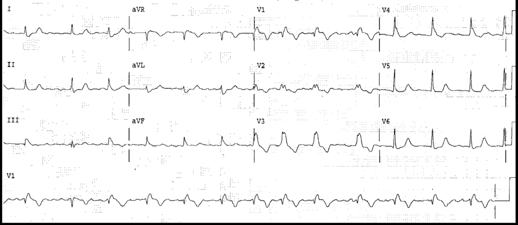 Atrial Fibrillation with Rate Related RBBB