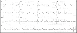 Read more about the article Atrial Fibrillation with Rate Related RBBB