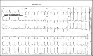 Read more about the article ECG Case 8
