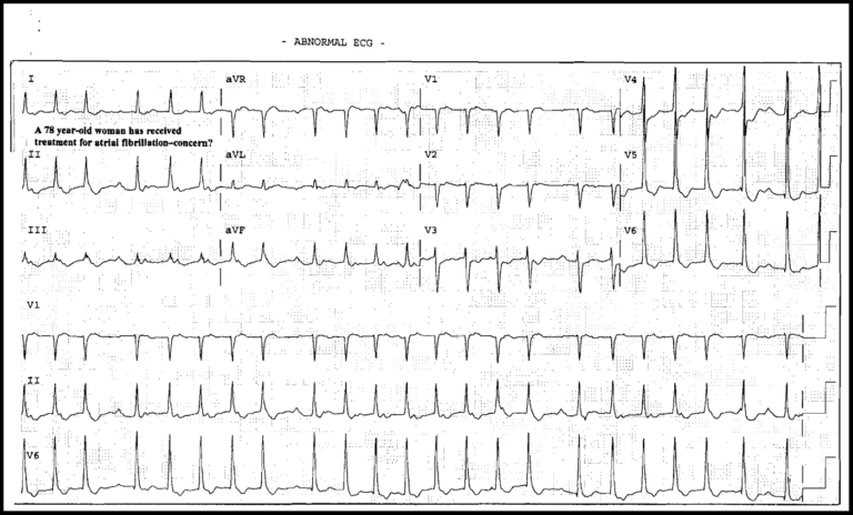 Read more about the article ECG Case 8