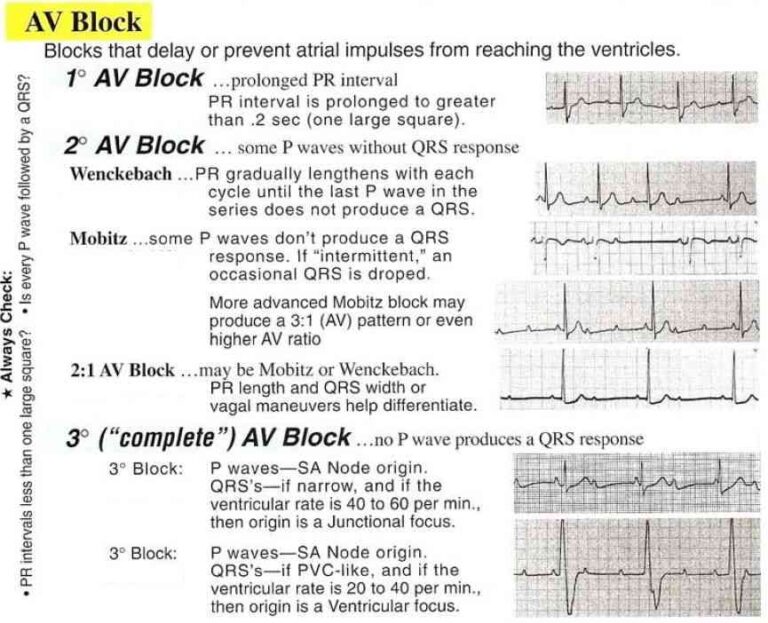 Read more about the article Conduction Blocks at the AV Node (AV Blocks)