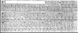Read more about the article ECG Case 9