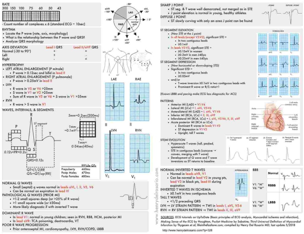 Ecg Case 85: Posterior Mi And Atrial Fibrillation - Manual Of Medicine