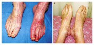 Read more about the article Left Foot Discoloration Resolved with Elevation