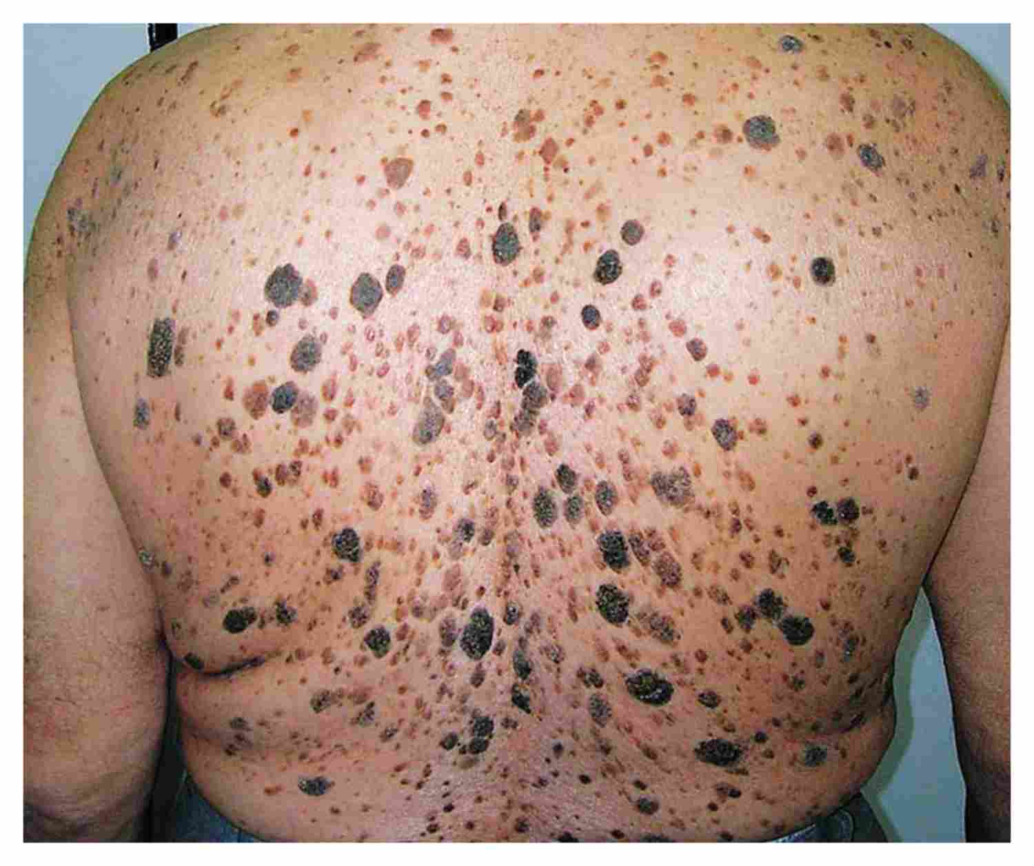 Black Cutaneous Lesions Manual Of Medicine