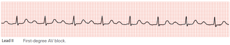 Conduction Blocks at the AV Node (AV Blocks) [With Examples] - Manual ...