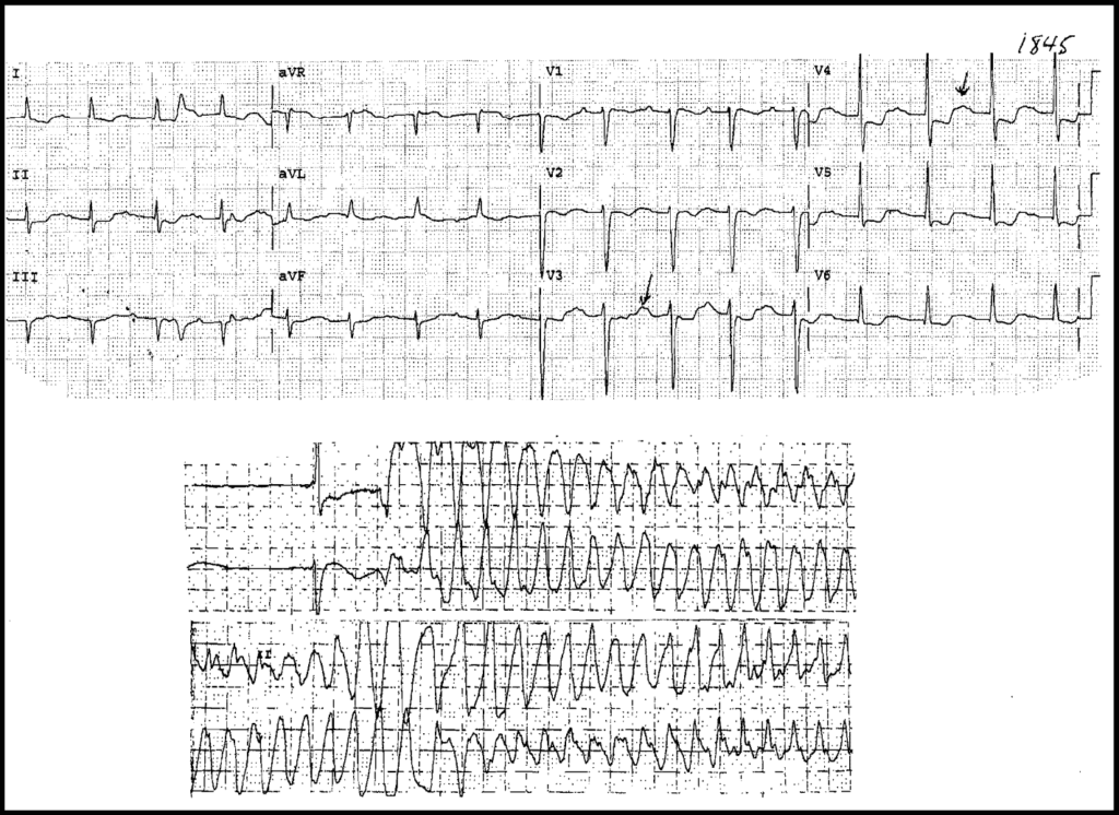Hypokalemia with Prolonged QT Interval that led to Ventricular Tachycardia (Torsades de pointes)