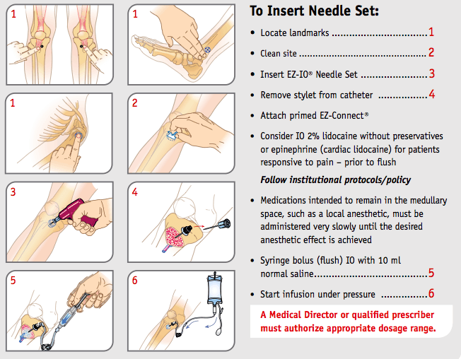 Inserting Intraosseous Line