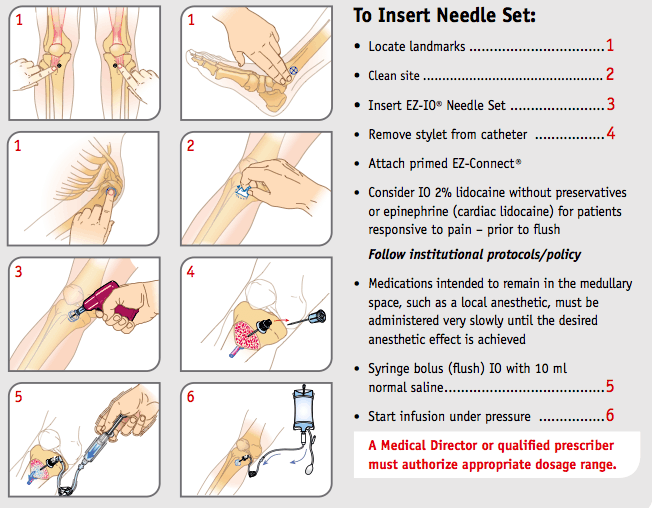 Intraosseous IO Access Manual Of Medicine