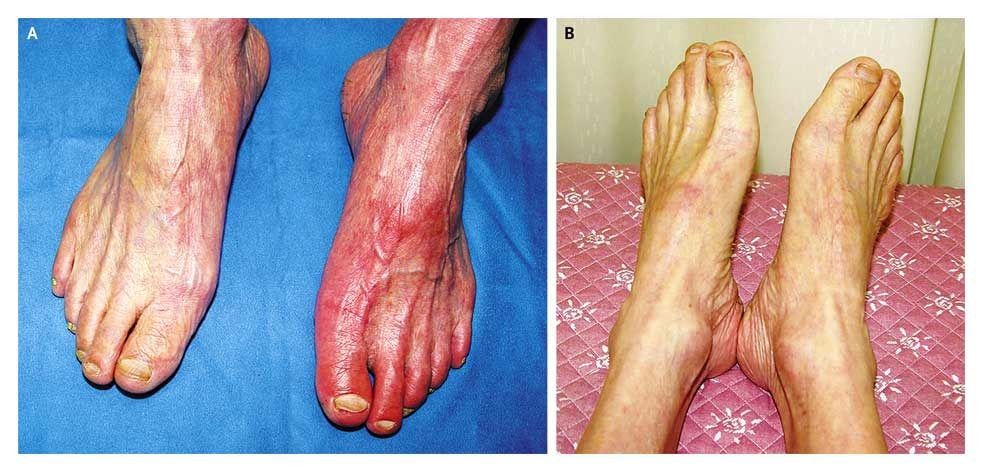 Left Foot Discoloration Resolved with Elevation