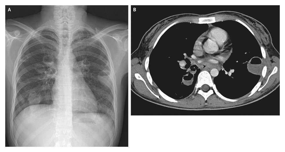 Multiple Pulmonary Bacterial Abscesses on CXR and CT