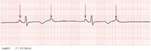 Conduction Blocks at the AV Node (AV Blocks) [With Examples] - Manual ...