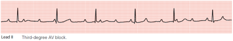Conduction Blocks at the AV Node (AV Blocks) [With Examples] - Manual ...