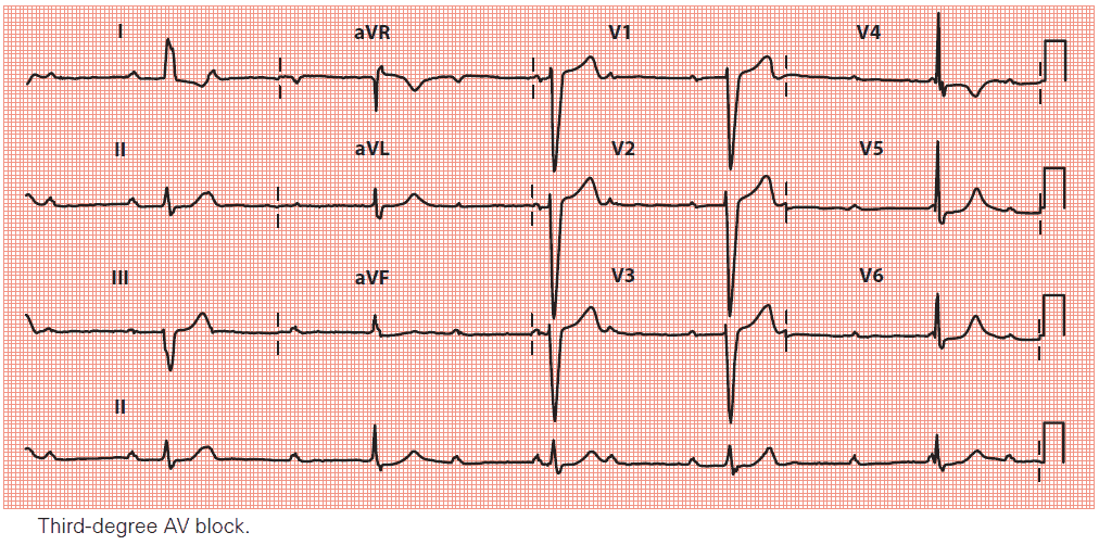 Third-degree AV block ECG