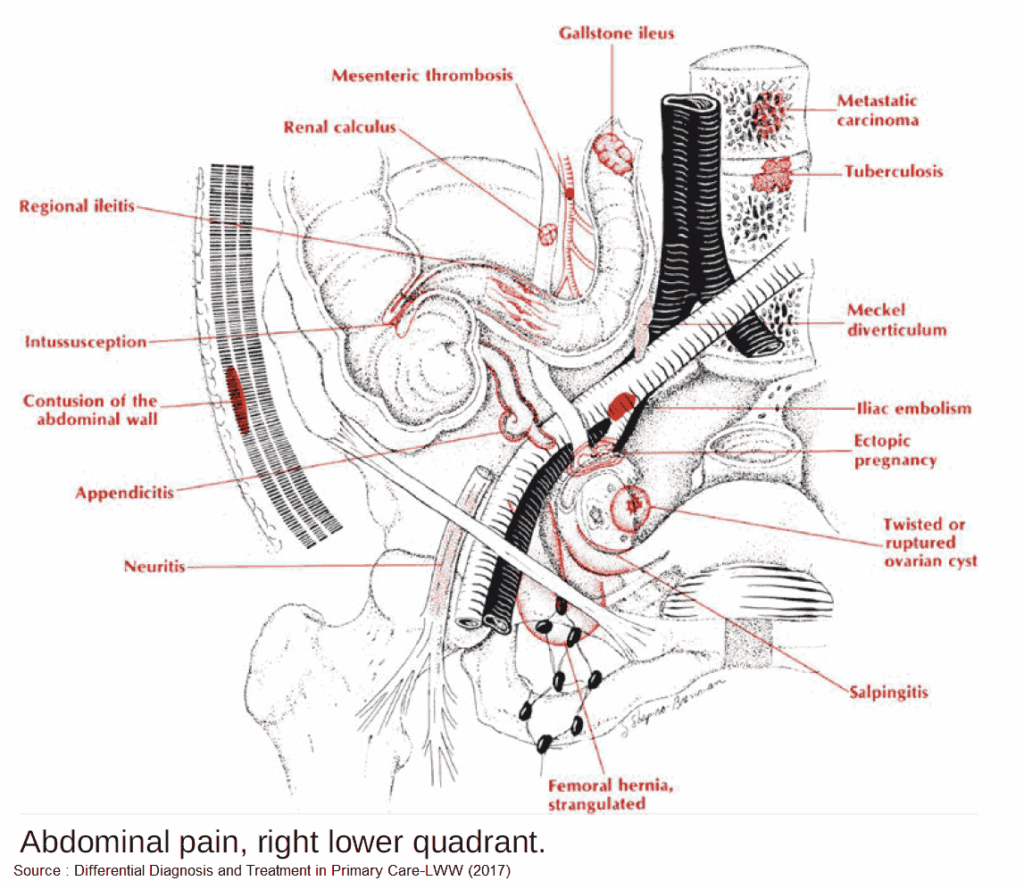 Differential Diagnosis for Abdominal Right Lower Quadrant (RLQ) Pain