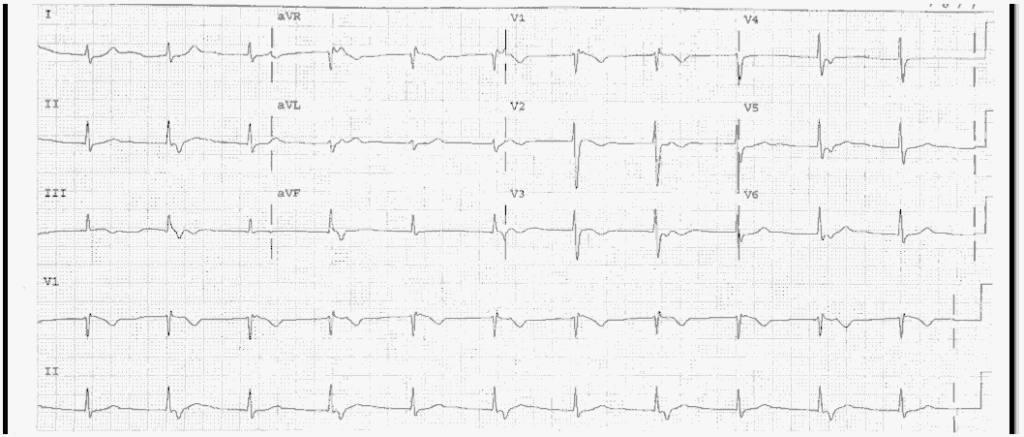 ECG Case 71: Atrial fibrillation with RVR, LAFB and Acute Anterolateral ...