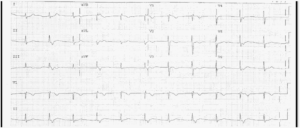 Read more about the article ECG Case 11