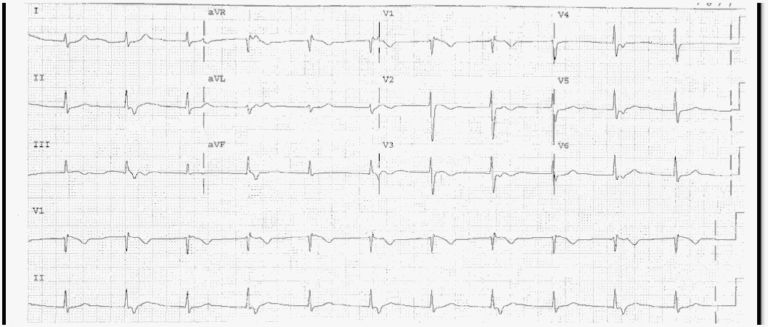 Read more about the article ECG Case 11