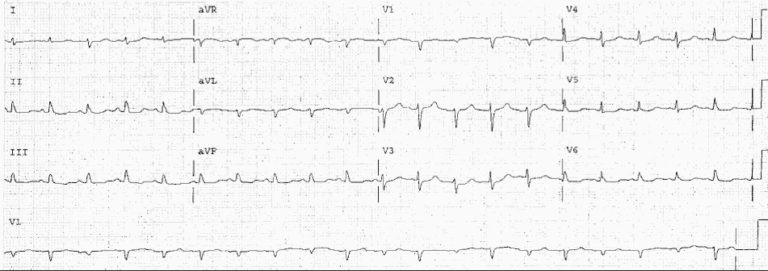 Read more about the article ECG Case 13