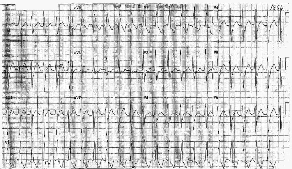 Ecg Case 220 - Manual Of Medicine