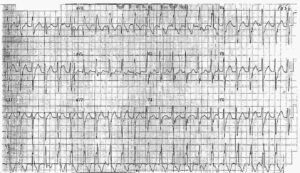 Read more about the article ECG Case 14