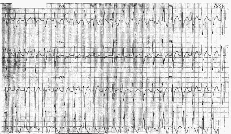 Read more about the article ECG Case 14