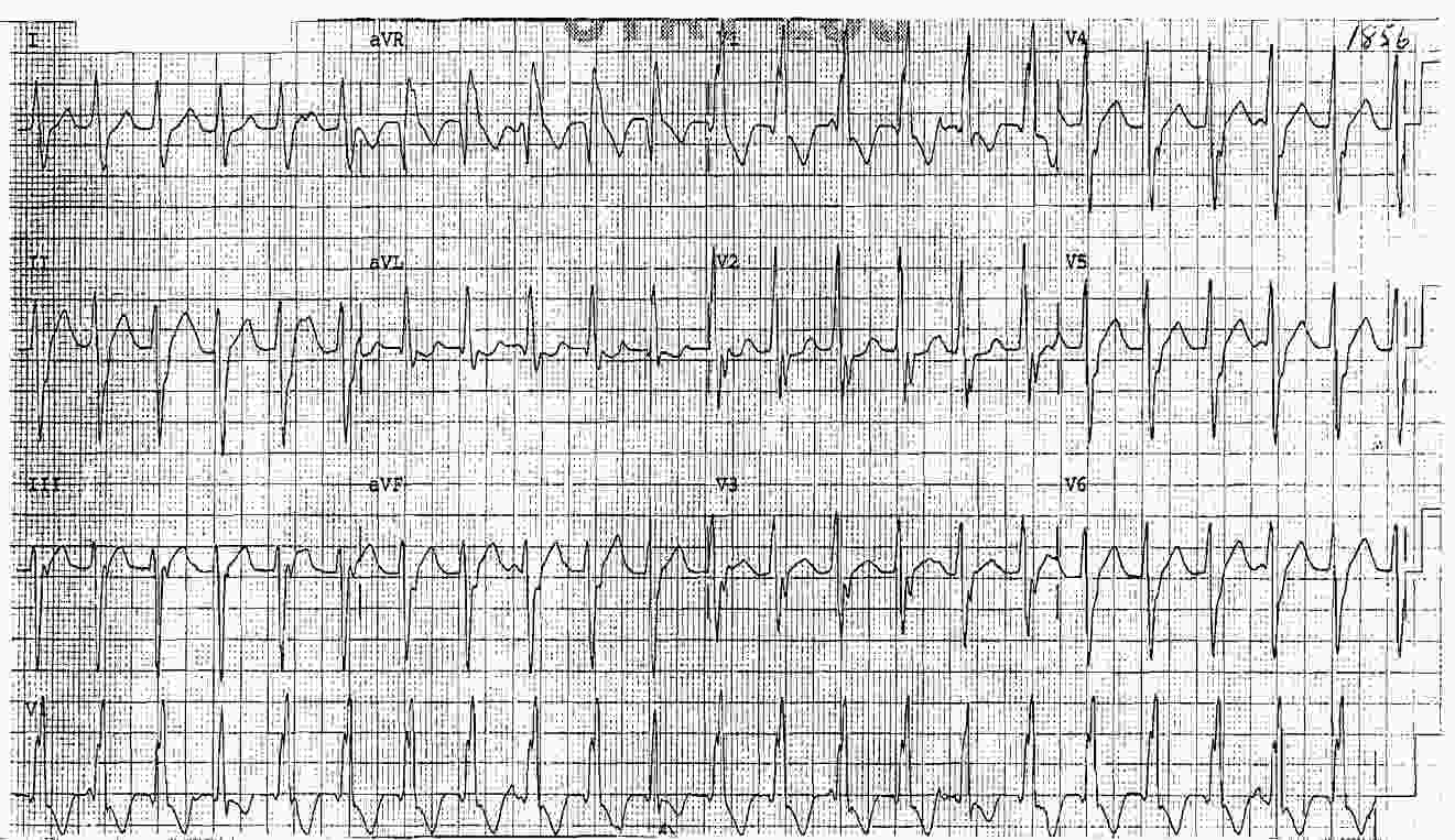 ECG Case 106: Left Atrial And Left Ventricular Hypertrophy (LVH ...