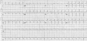Read more about the article Atrial Flutter with 2:1 Conduction