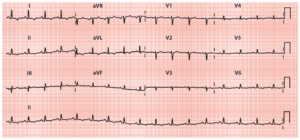 Read more about the article Low QRS Voltage on the ECG