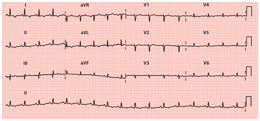 low-qrs-voltage-on-the-ecg-manual-of-medicine