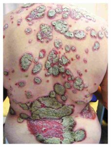 Read more about the article Sharply Demarcated, Erythematous, Plaques Covered with Scales and Crust