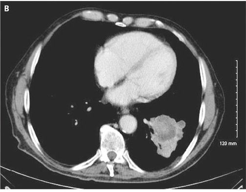 Lung Cancer on CT