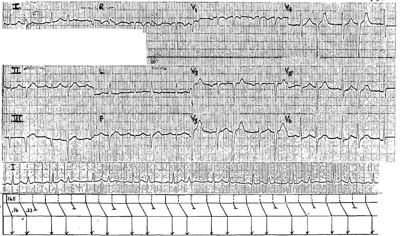 Atrial Tachycardia with 3:2 AV Block Mobitz I Wenckebach