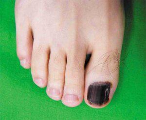 Read more about the article Black Nail