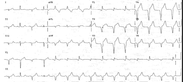 Read more about the article ECG Case 17