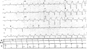 Read more about the article Accelerated Idioventricular Rhythm (AIVR) with Isochronic AV Dissociation