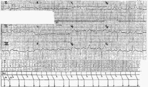 Read more about the article Atrial Tachycardia with 3:2 AV Block Mobitz I Wenckebach