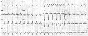 Read more about the article Atrial Flutter 2:1 Conduction